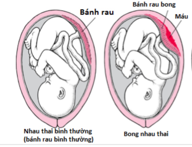 hình ảnh mô tả nhau thai bình thường và nhau thai bất thường